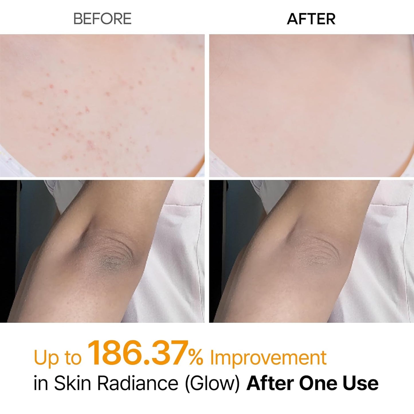 Dr.Melaxin Body Keratin Care Kojic Acid Turmeric Spray Gently Exfoliating Peeling Solution  Skincare All Skin Types 200ml